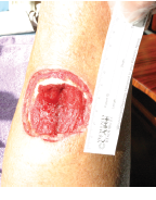 Figure 2 from Honebrink et al. 2011, showing the extent of the sharkbite injury after 7 days 