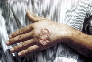 Skin ulcer on the hand due to leishmaniasis. (Photo credit: CDC Dr. S. Martin)