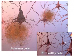The buildup of toxic waste proteins causes brain cells to die in Alzheimer's disease. (Photo credit: alz.org)