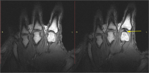Pull My Finger experiment. Static images of the hand in the resting phase before cracking (left). The same hand following cracking with the addition of a post-cracking distraction force (right). Note the dark, interarticular void (Photo credit: Kawchuck et al. 2015, PLoS ONE)